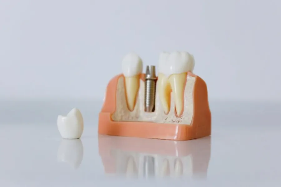 dental dentures vs bridges