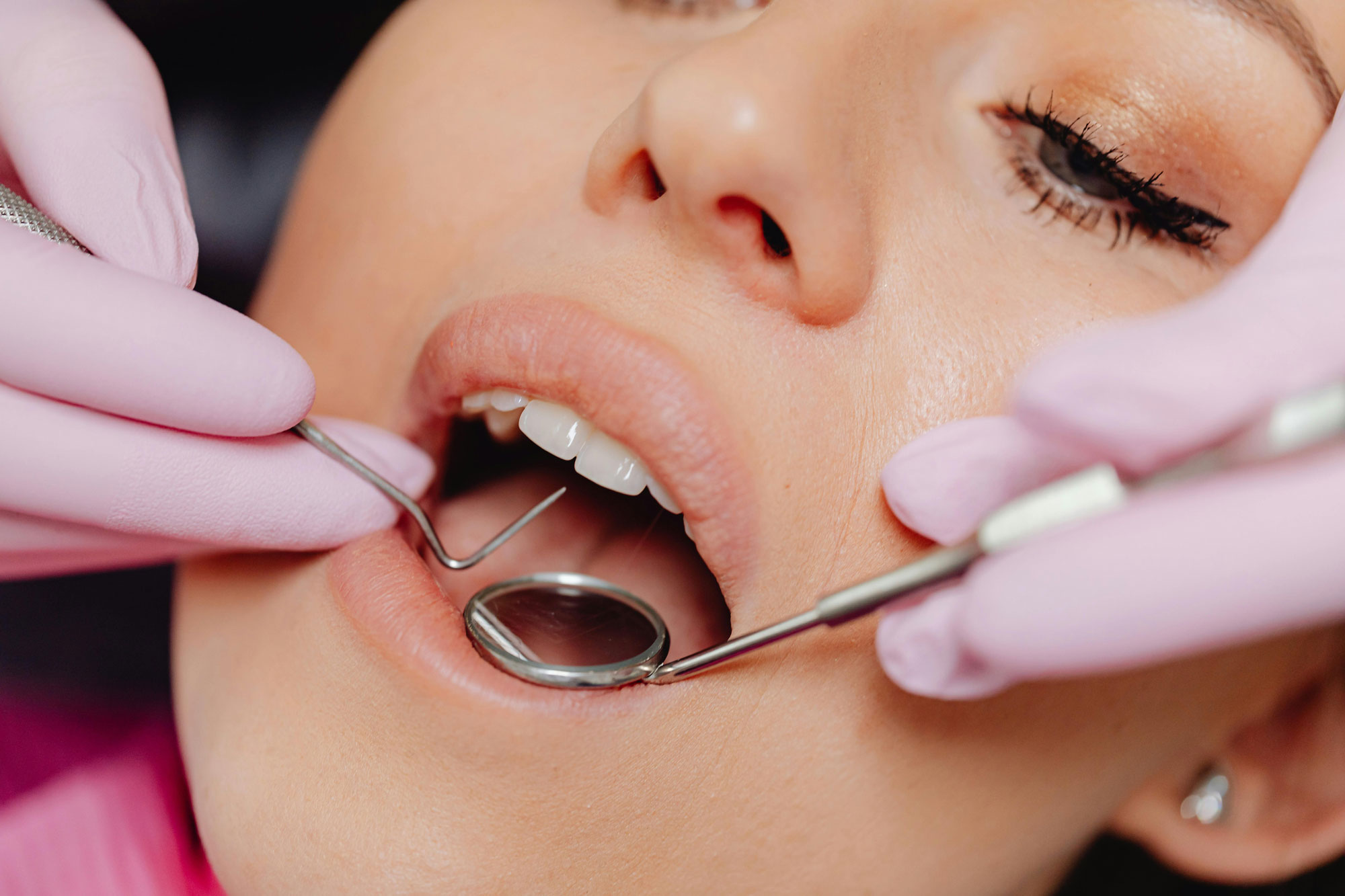 What to Expect During the Root Canal Recovery Process