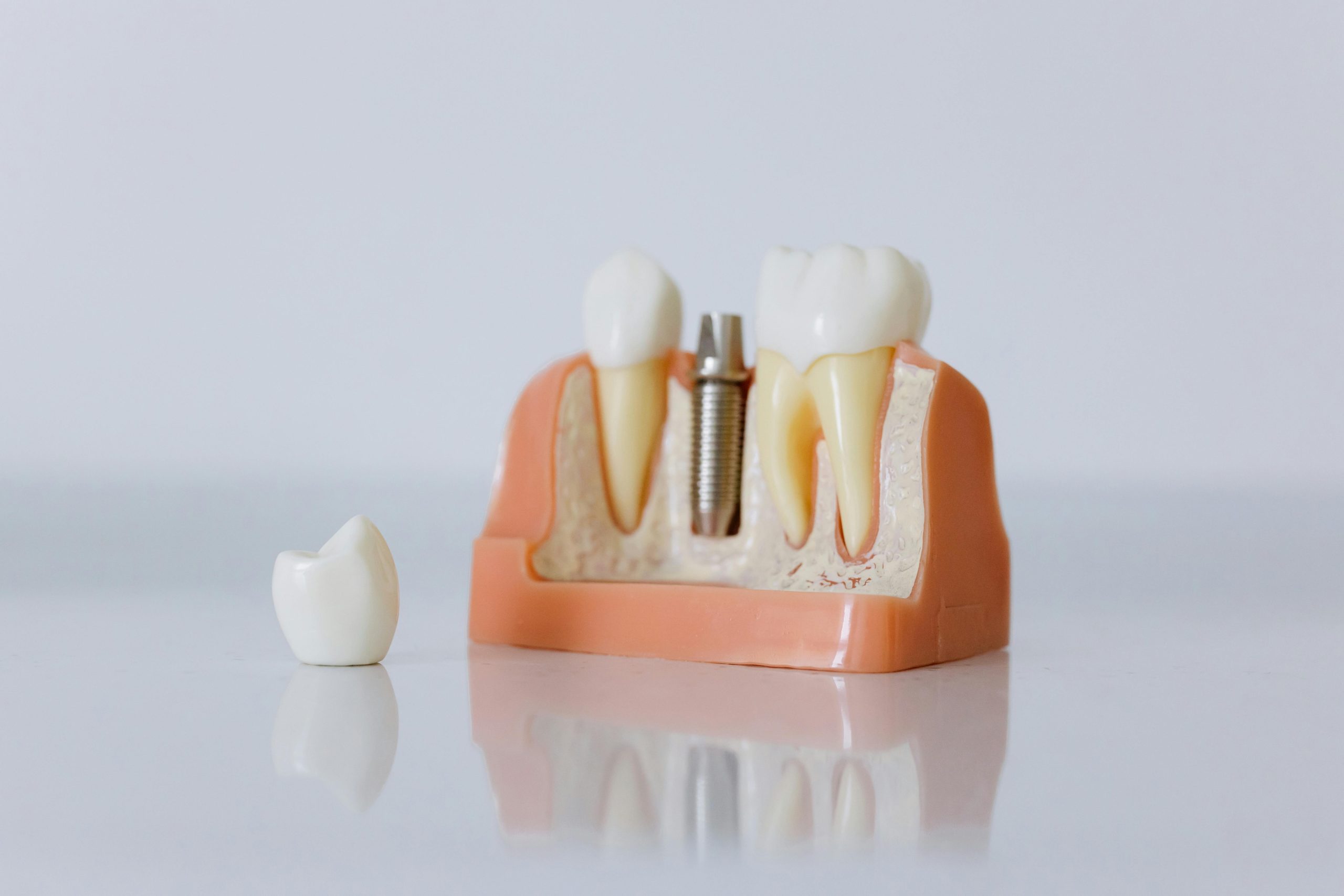 Comparing Dental Bridges and Dentures: Which is Right for You?