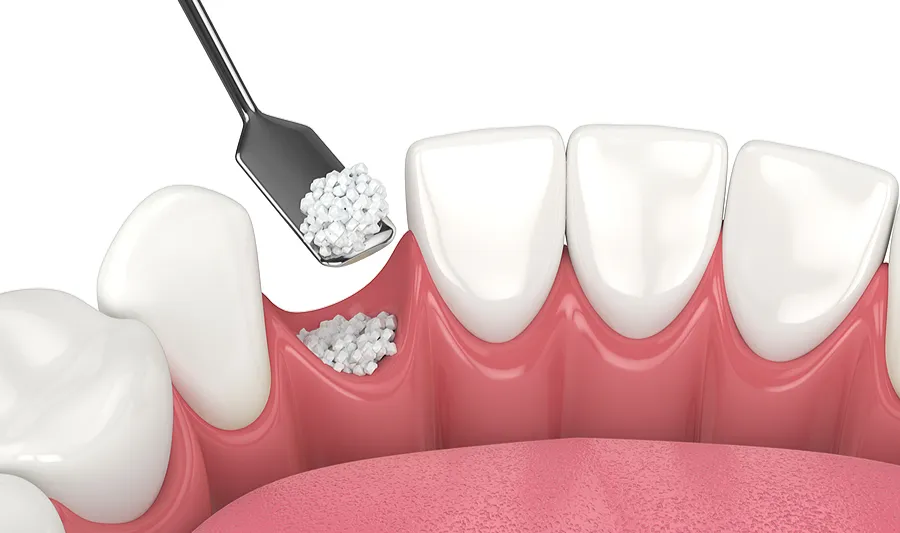 bone grafting
