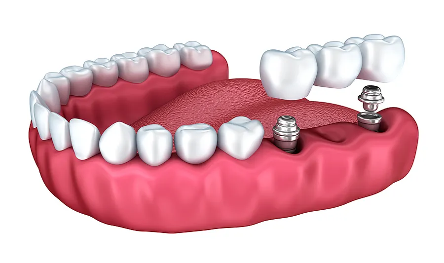 dental implants