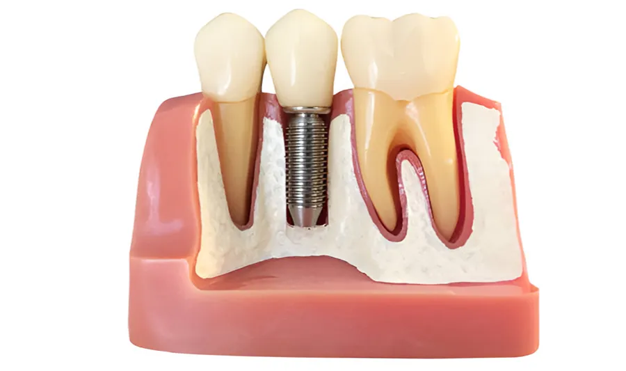 implant dentistry