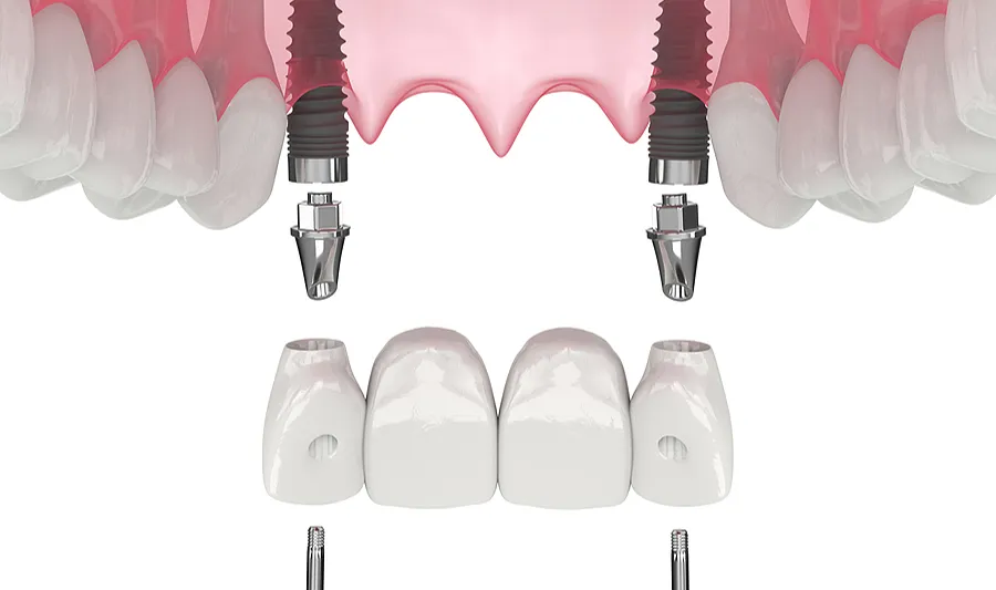 implant supported dentures