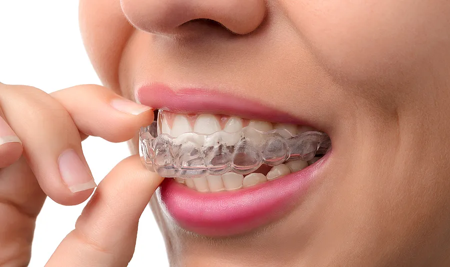 invisalign