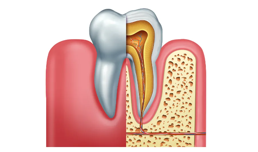 root canal