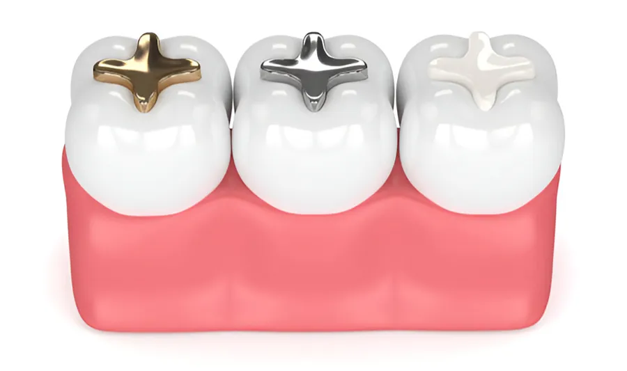 tooth colored fillings