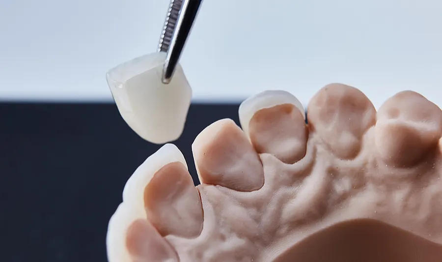 veneers