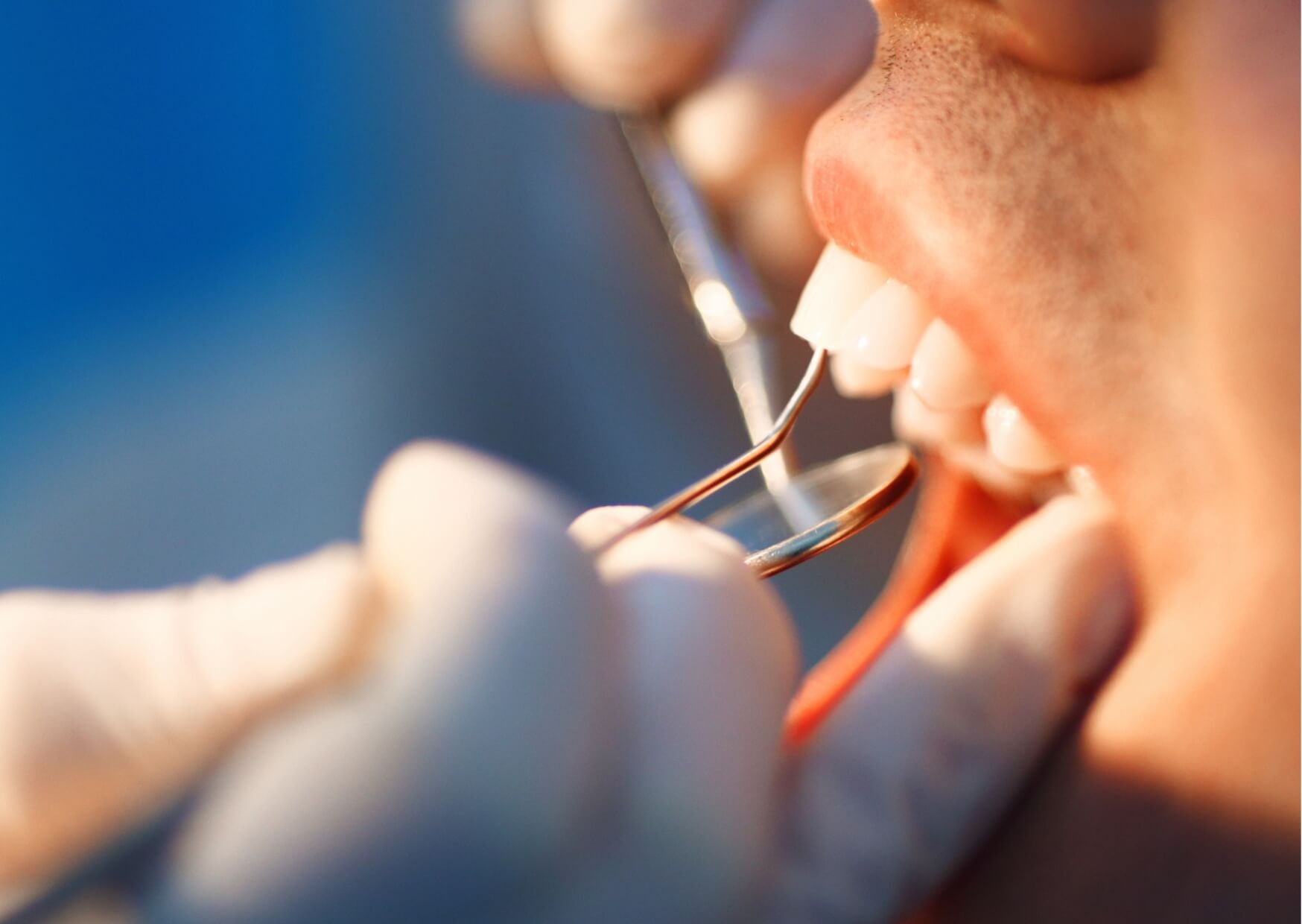 Close-up of a dentist examining teeth during a cosmetic dentistry consultation for dental bonding and veneers
