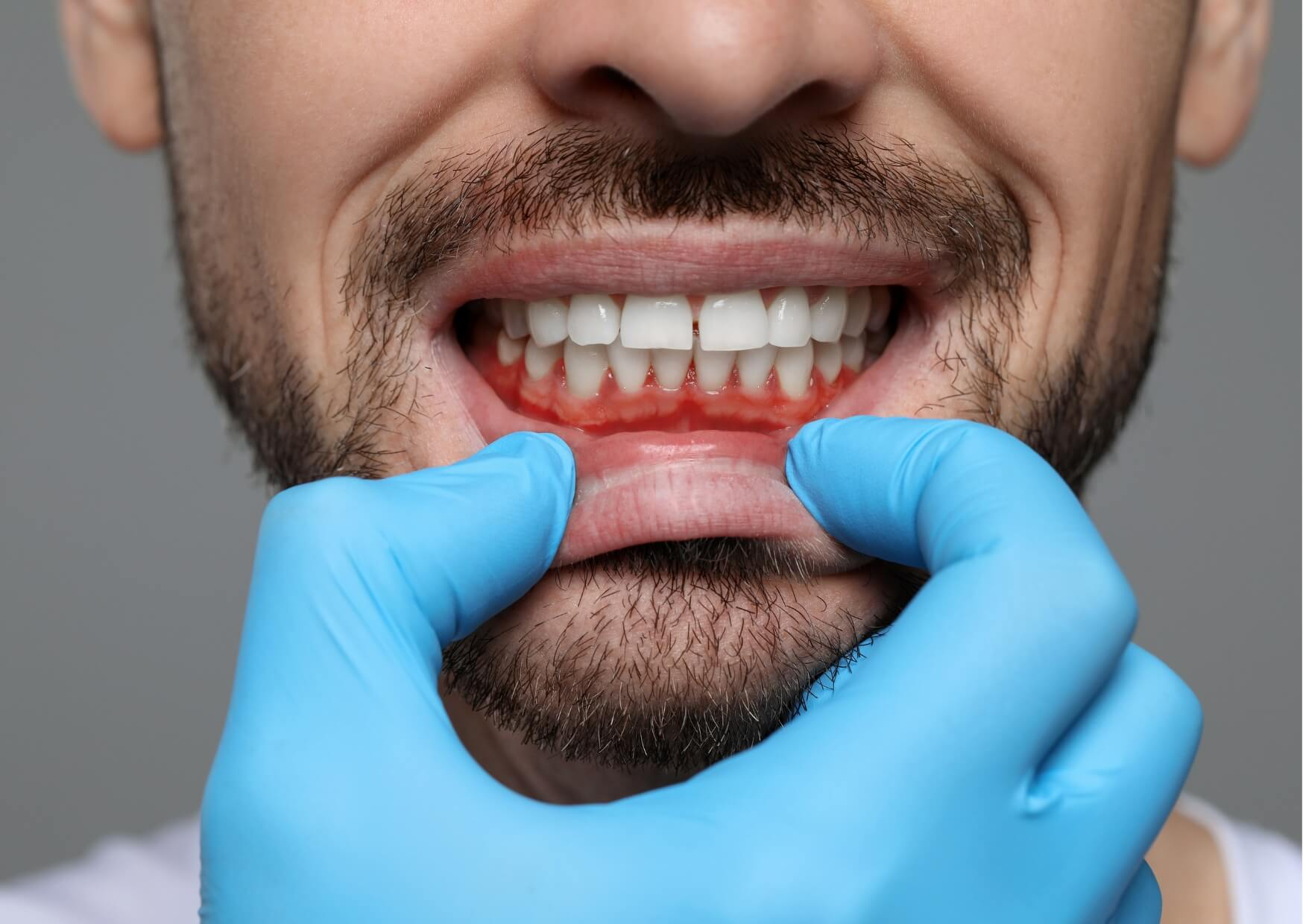 Close-up of red, swollen gums showing common signs of gingivitis and early gum disease around the lower front teeth.