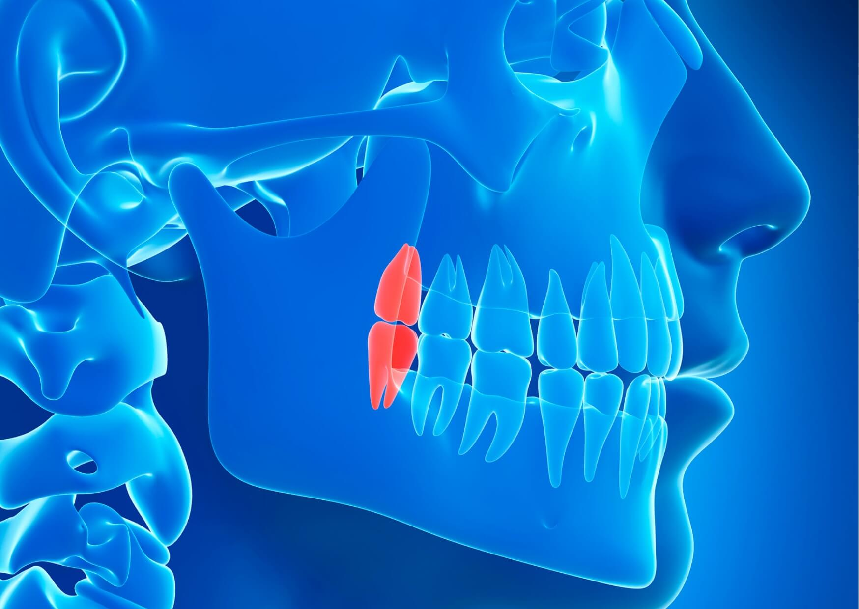 Illustration showing a wisdom tooth coming in at the back of the jaw behind the second molar.