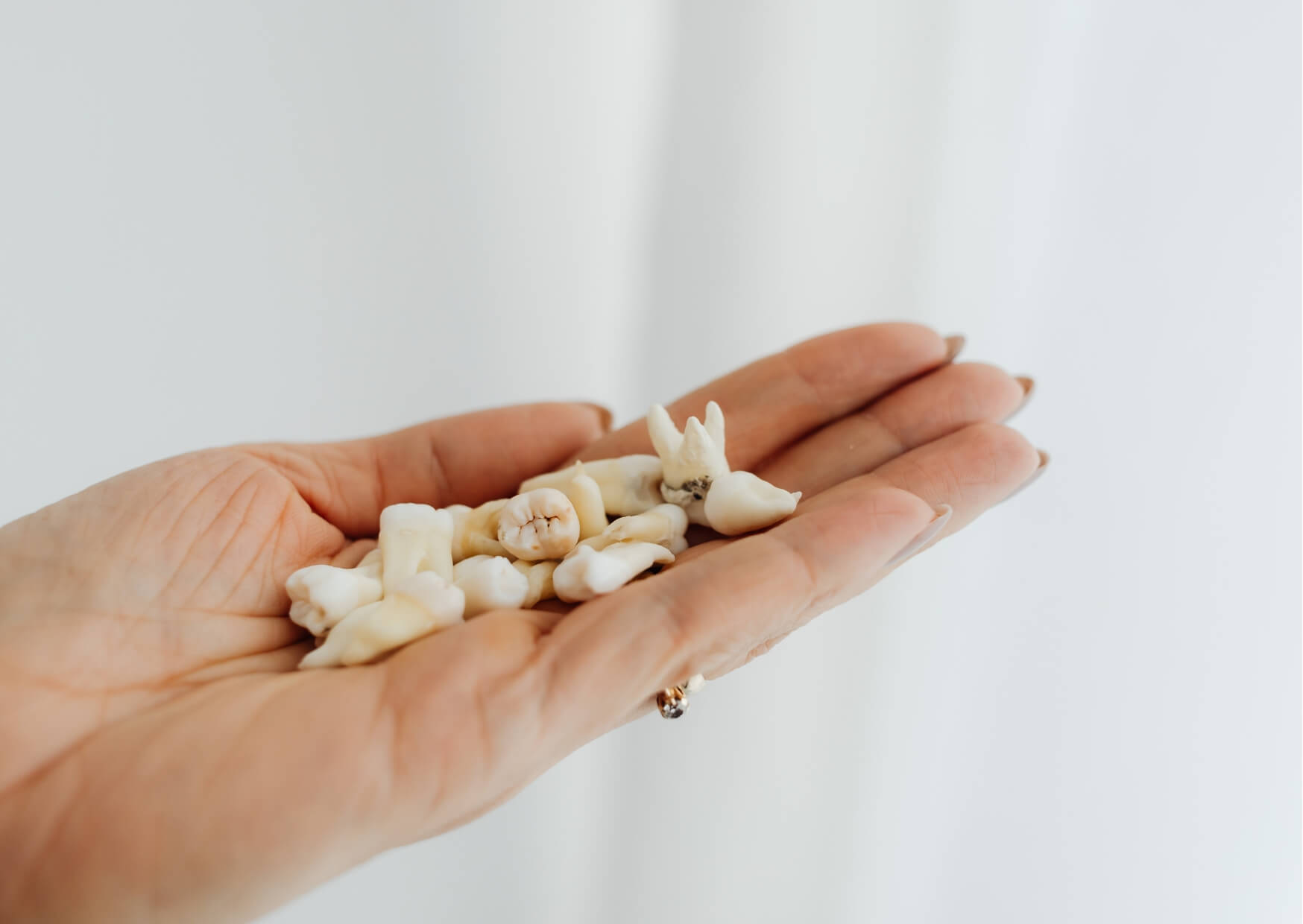 Extracted adult teeth displayed in a hand, illustrating possible outcomes when a loose adult tooth cannot be saved.