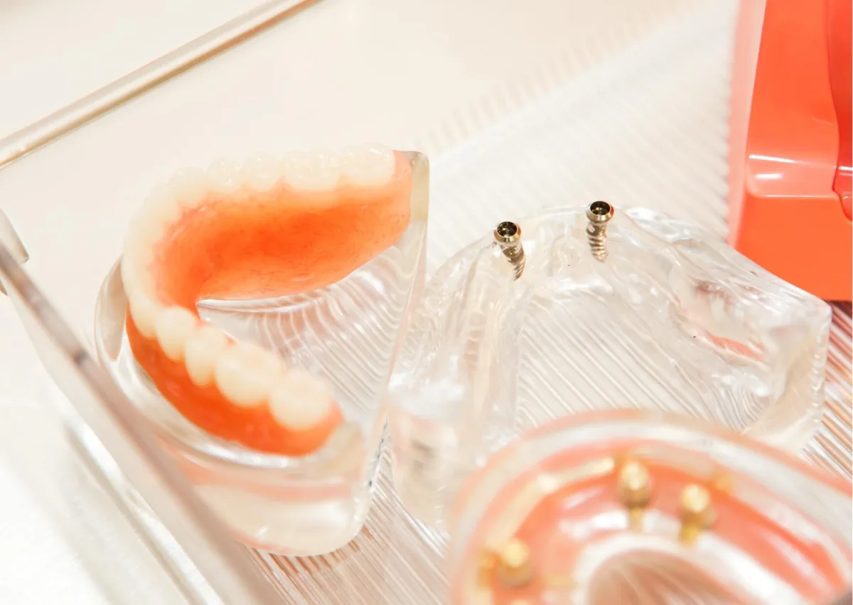 Dental models showing removable dentures and implant-supported teeth for a dentures vs. implants comparison.