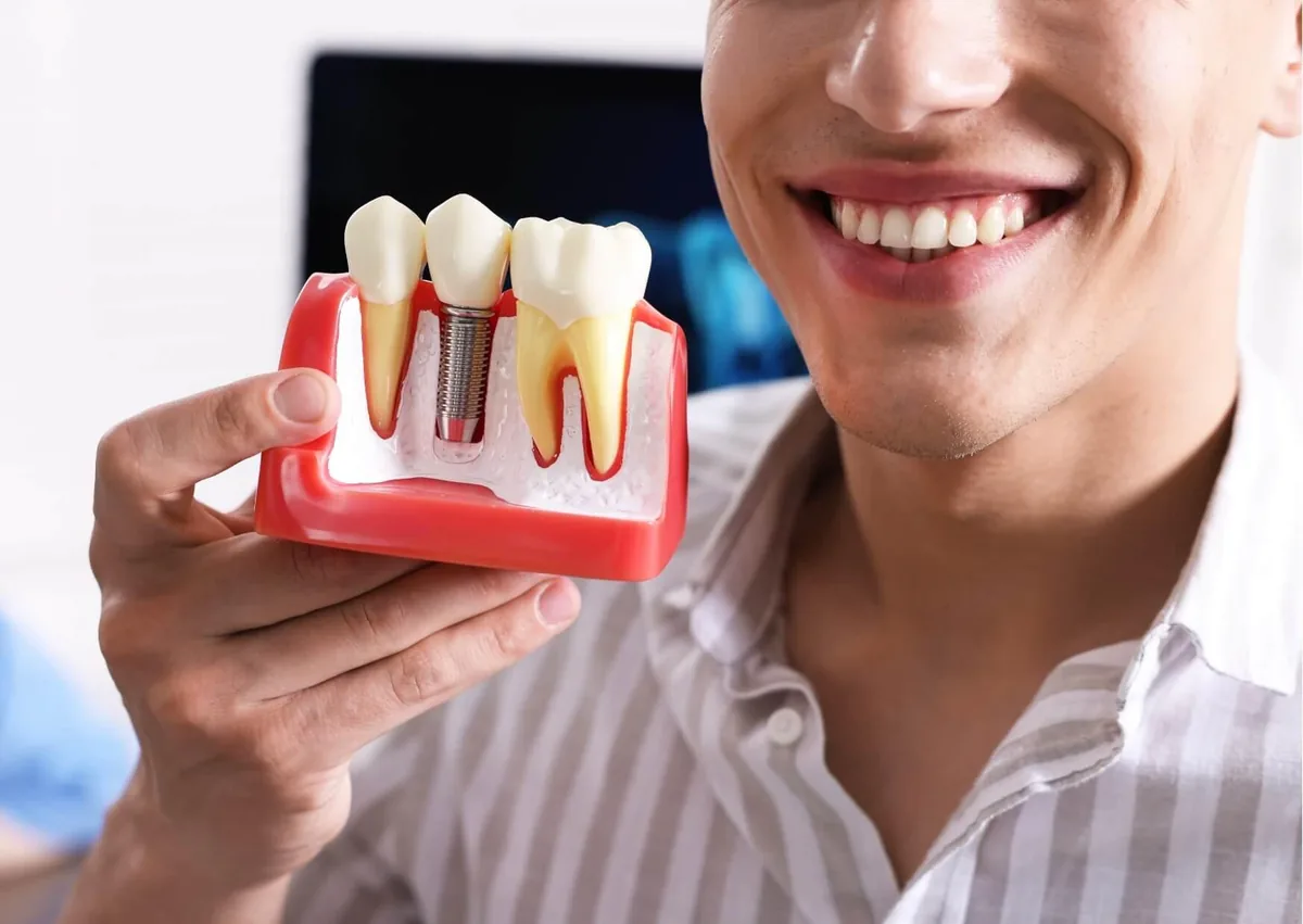 Dental implant model showing how a tooth implant replaces a missing tooth during treatment.