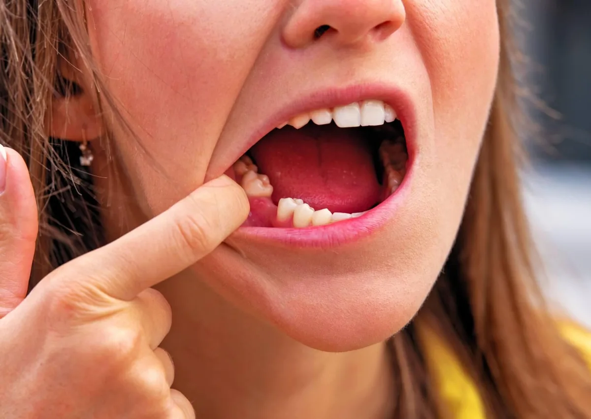 Patient checking a tooth extraction socket while monitoring signs of normal healing.